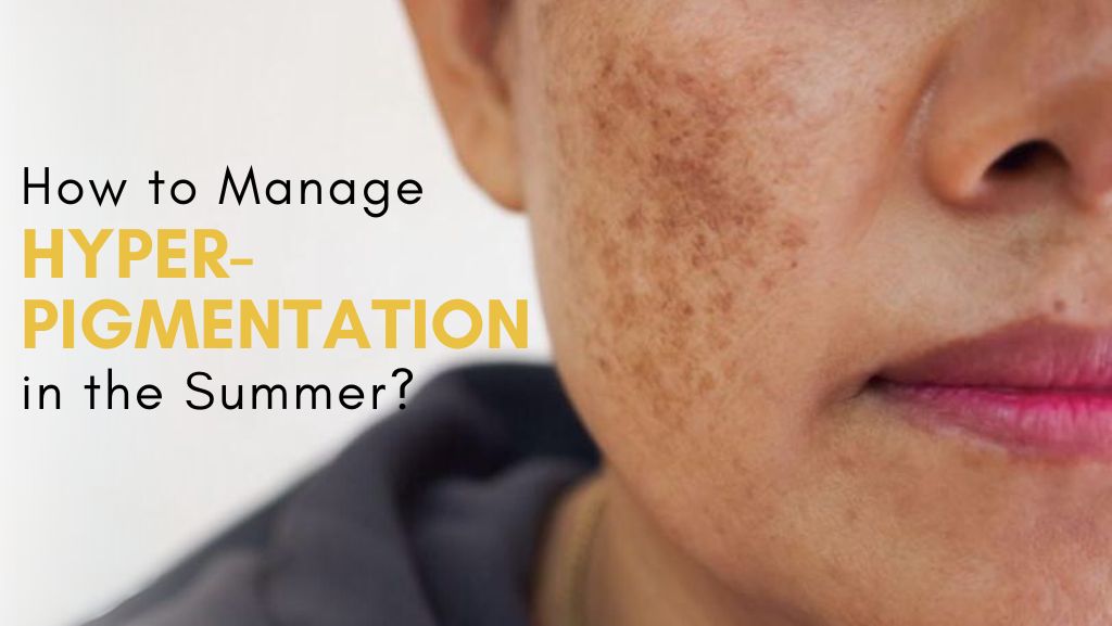 control hyperpigmentation in the summer